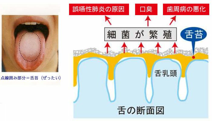 舌ブラシ W-1 ダブルワンネクスト